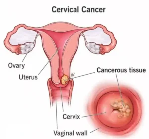 Cervical Cancer